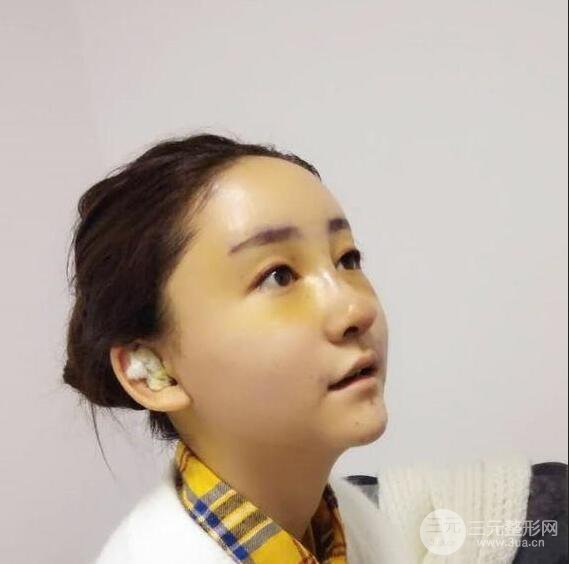 广州名韩医疗美容卓敬锡“隆鼻整形+自体脂肪填充全脸”案例分享，整完有点像景甜