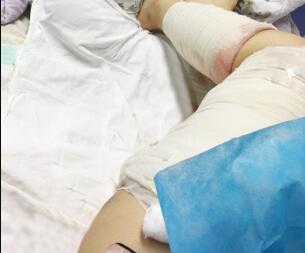 水动力吸脂瘦大腿让我告别小粗腿 快来看看果