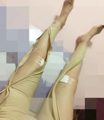 水动力吸脂瘦大腿让我告别小粗腿 快来看看果