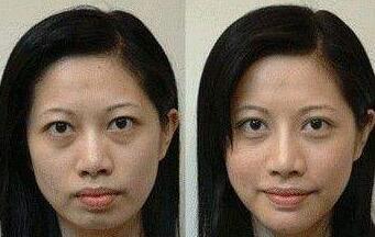 垫下巴的方法分为四种:玻尿酸垫下巴、自体脂肪垫下巴、膨体垫下巴、硅胶垫下巴。