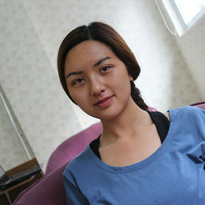 双眼皮手术前后对比果照片分享，北京美莱做的~