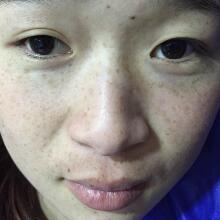 在南京光尔美医疗美容医院做的激光祛斑缓解分享