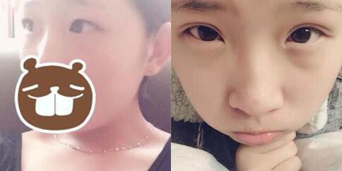 割双眼皮前后对比图,眼睛整形价格