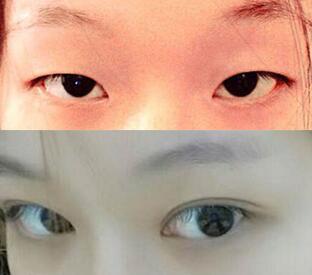 单眼皮割双眼皮价格和果图