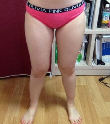 抽脂减肥瘦大腿价格10800元,一个月后恢复很好