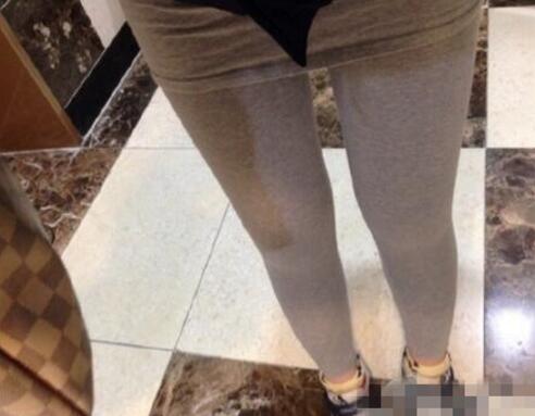 抽脂减肥瘦大腿价格10800元,一个月后恢复很好