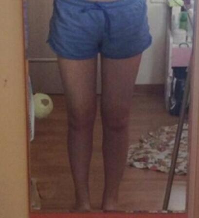 抽脂减肥瘦大腿价格10800元,一个月后恢复很好