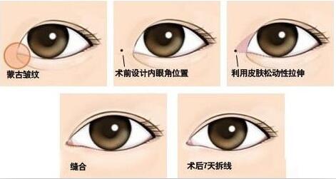 开内眼角原理图,开眼角大约多少钱