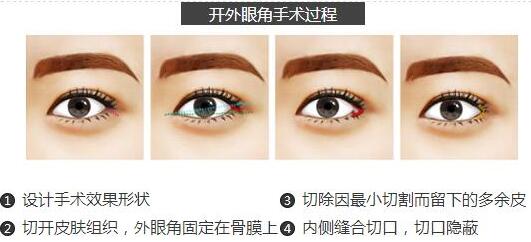 开外眼角原理图,开眼角多少钱