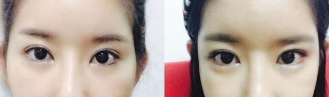 开外眼角前后对比图,开眼角价格