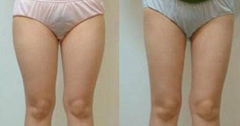 吸脂减肥瘦大腿前后对比图