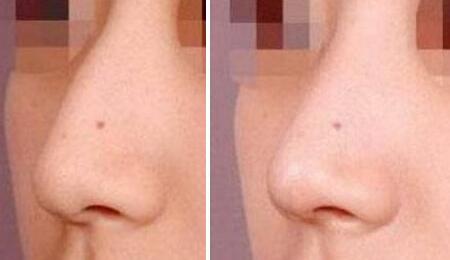 驼峰鼻矫正前后对比图,鼻子整形图片