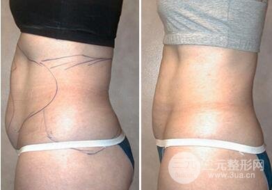 腹部吸脂凹陷应该怎么办?