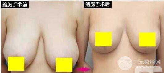 乳房缩小图片