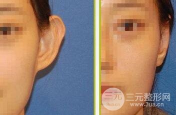 招风耳整形医院哪家好?整形医院推荐