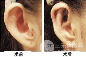 招风耳整形医院哪家好?整形医院推荐