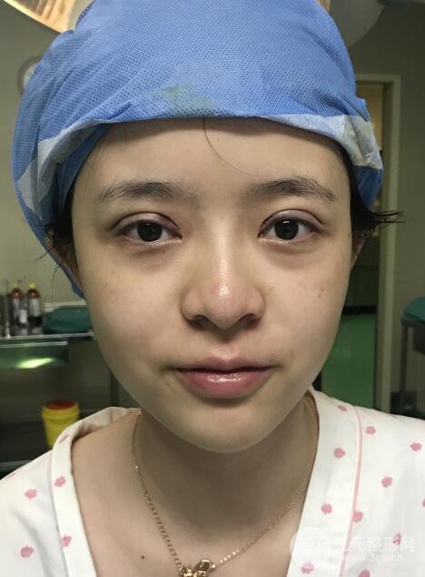 割双眼皮手术价格和1-7恢复图片案例