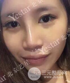 北京艺星仇侃敏耳软骨隆鼻恢复过程|内附前后对比图