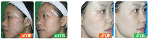 彩光嫩肤前后对比(图)
