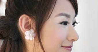 酒窝再造术还你甜美笑容