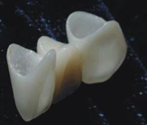 全瓷牙的使用寿命是多长?