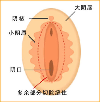 韩式小阴唇整形术