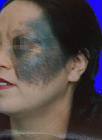 太田痣的常规分类有哪些？