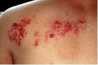 皮肤病的皮肤病理