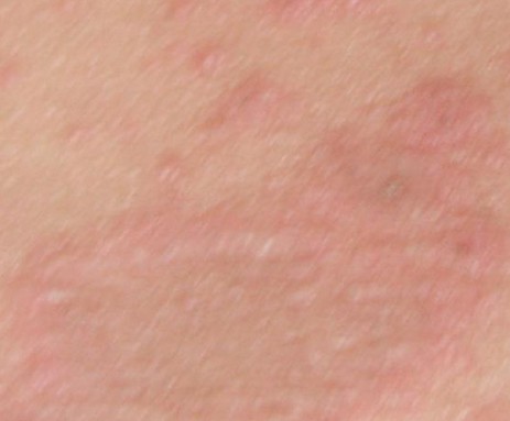 皮肤病的常见分类