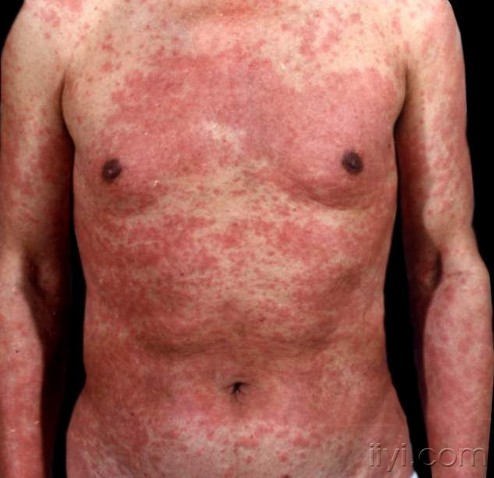 常见皮肤病的主要症状