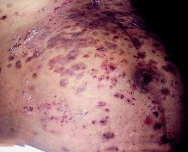 妊娠期皮肤病相关介绍