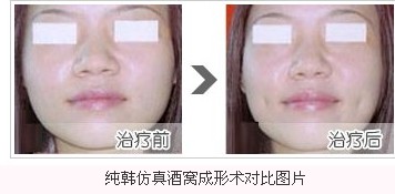 纯韩仿真酒窝成形术前后对比图片