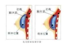 假体隆胸的相关简介