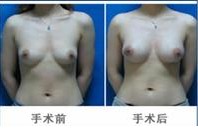 隆胸假体体内保持的时间