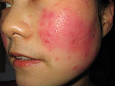 面部发红型红血丝形成的原因
