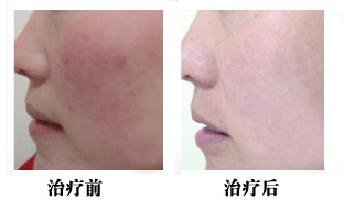 红血丝终结者