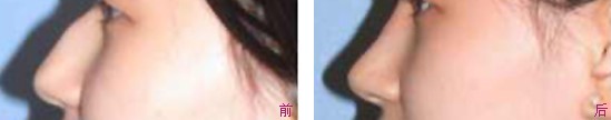 鼻翼缩小手术是鼻部整形手术中的重点
