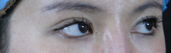 失败留疤开眼角修复