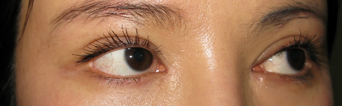 失败留疤开眼角修复