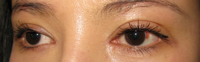 失败留疤开眼角修复