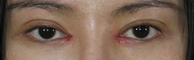 失败留疤开眼角修复