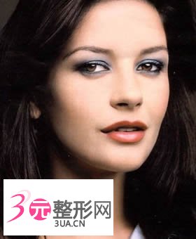 颧骨缩小术