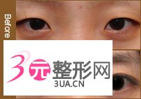 切开双眼皮