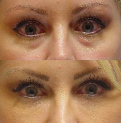 Juvederm来撕低谷