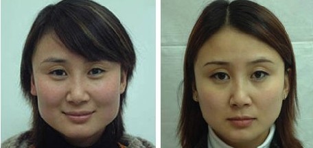 下颌角整形适合哪些情况做