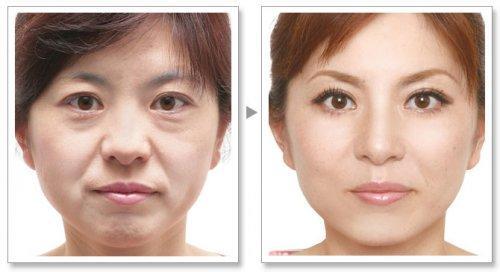 上海九院做个拉皮手术大概需要多少钱