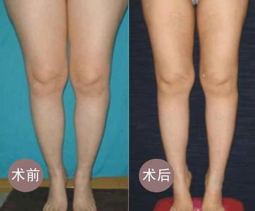 上海九院大腿吸脂多少钱呢?