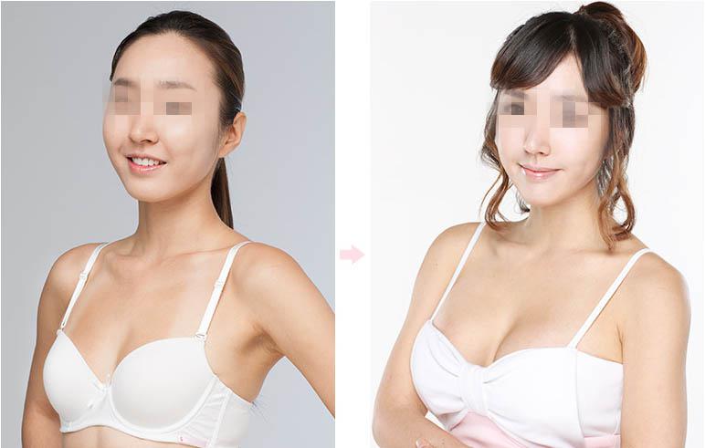 上海九院胸部整形要多少钱?