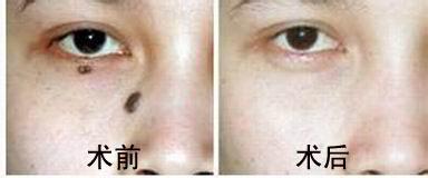 激光去痣有哪些优势