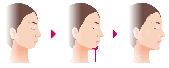 做垫下巴手术多少钱